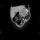 Adrenal tumour, extensive: CT - Computed tomography